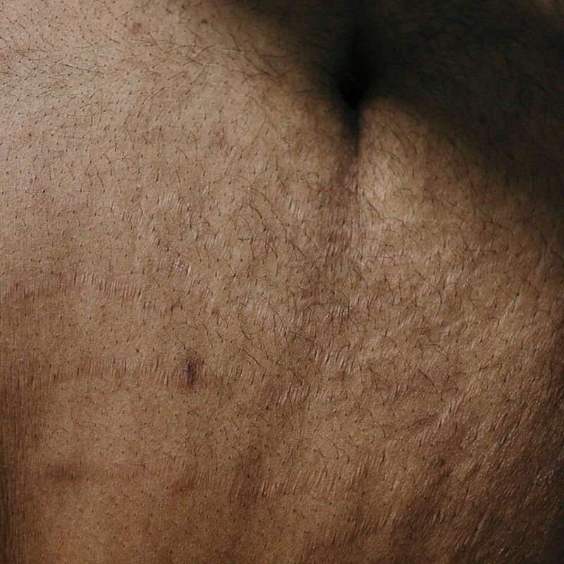 Closely cropped photograph of skin. Pores and dark hair is visible, as well as shiny, linear patches of skin that might be scars.